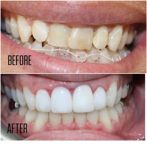 invisalign snaggletooth before and after.